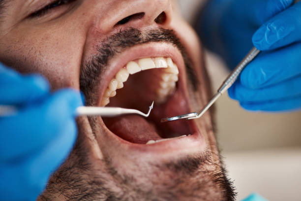 Best Broken or Chipped Tooth Repair in Clayco, MO